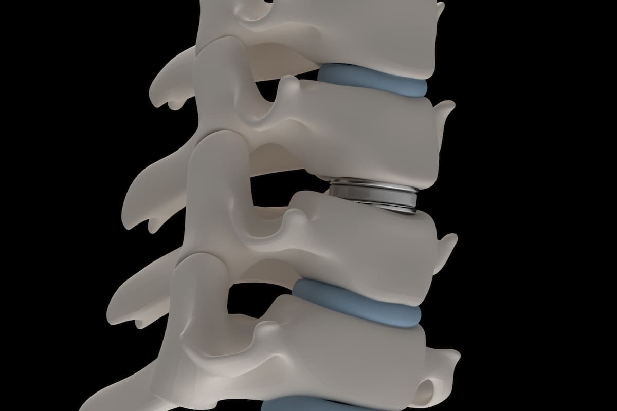 Artificial intervertebral disc prosthesis is installed between the cervical vertebrae
