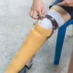 New aluminum prostheses legs for amputee patient