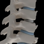 Artificial intervertebral disc prosthesis is installed between the cervical vertebrae Artificial intervertebral disc prosthesis is installed between the cervical vertebrae