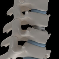 Artificial intervertebral disc prosthesis is installed between the cervical vertebrae